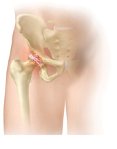 Hip Arthritis