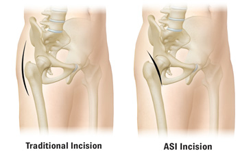 Traditional Incision vs ASI Incision