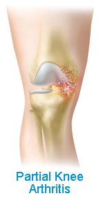 Partial Knee Arthritis