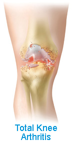 Total Knee Arthritis